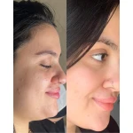 DERMACY Peeling Solution AHA&BHA